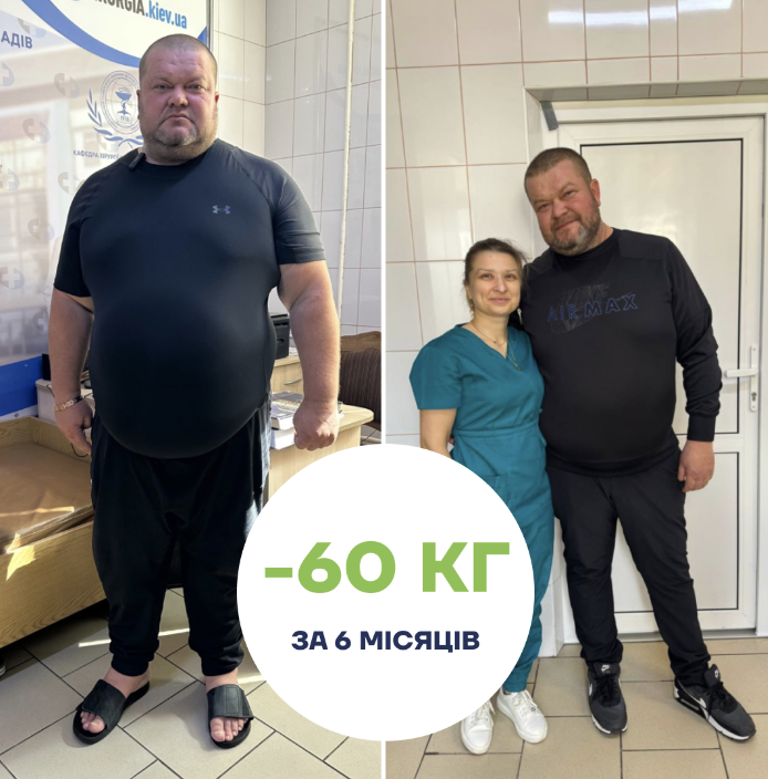 Maki med История успеха господина Валерия после рукавной резекции желудка before