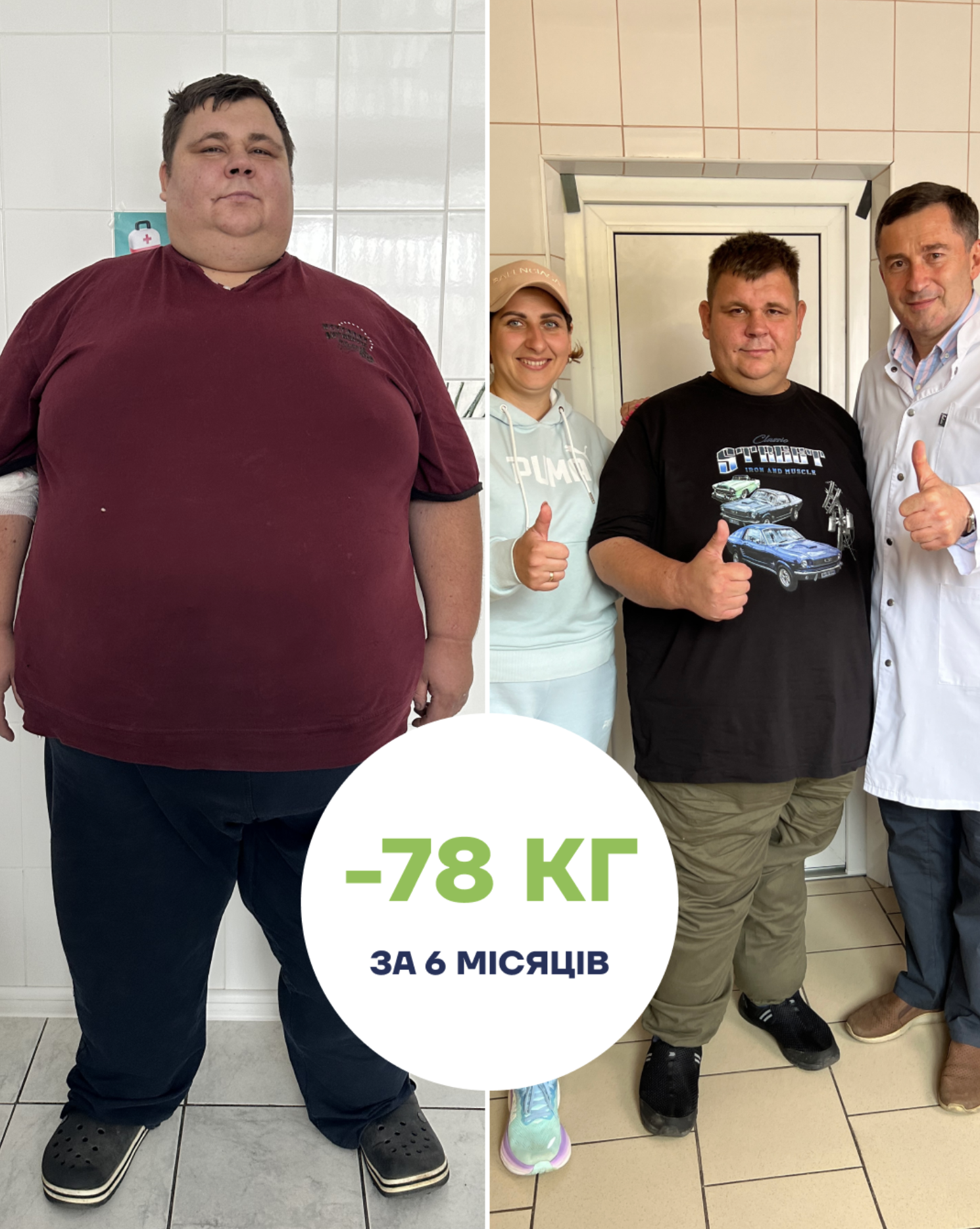 Maki med История успеха Максима после рукавной резекции желудка before