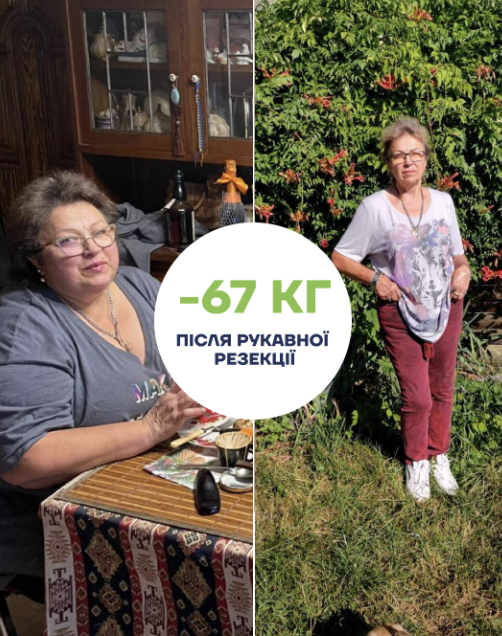 Maki med История успеха Татьяны после рукавной резекции желудка before