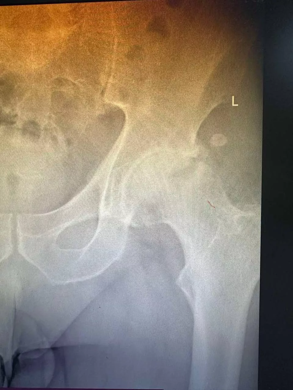 Пацієнт №1 - До 