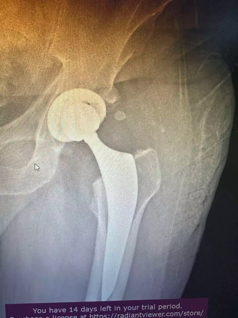 Пацієнт №1 - Після