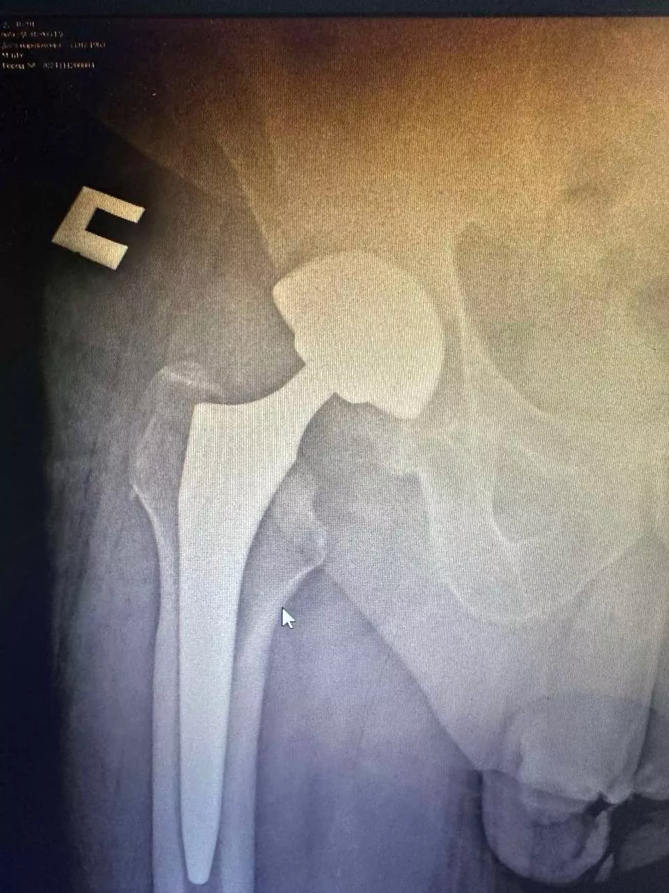 Пацієнт №2 - Після