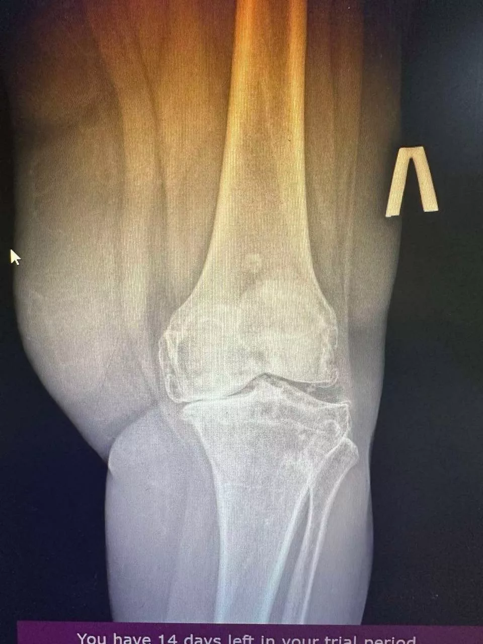 Пацієнт №3 - До 