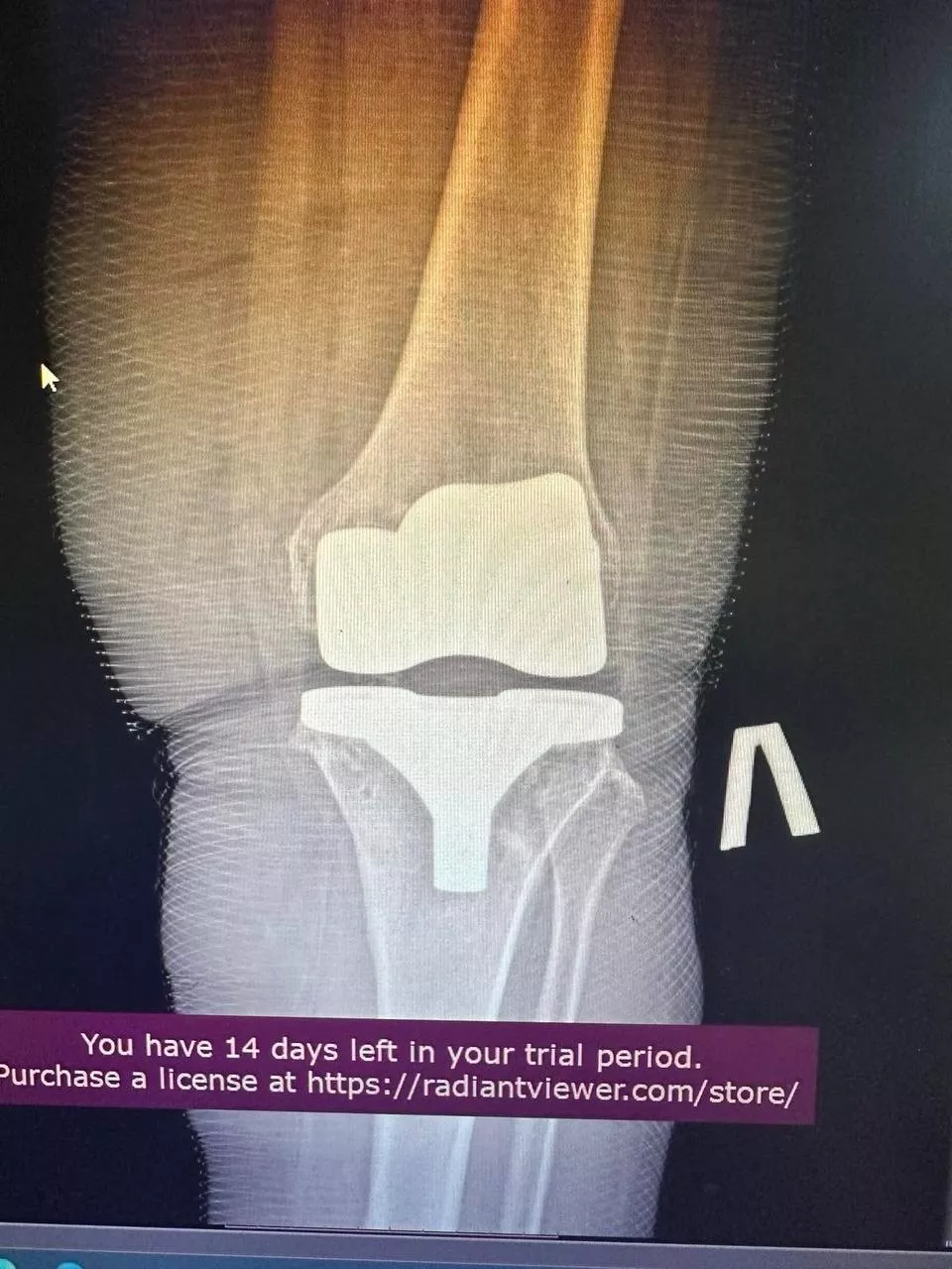 Пацієнт №3 - Після