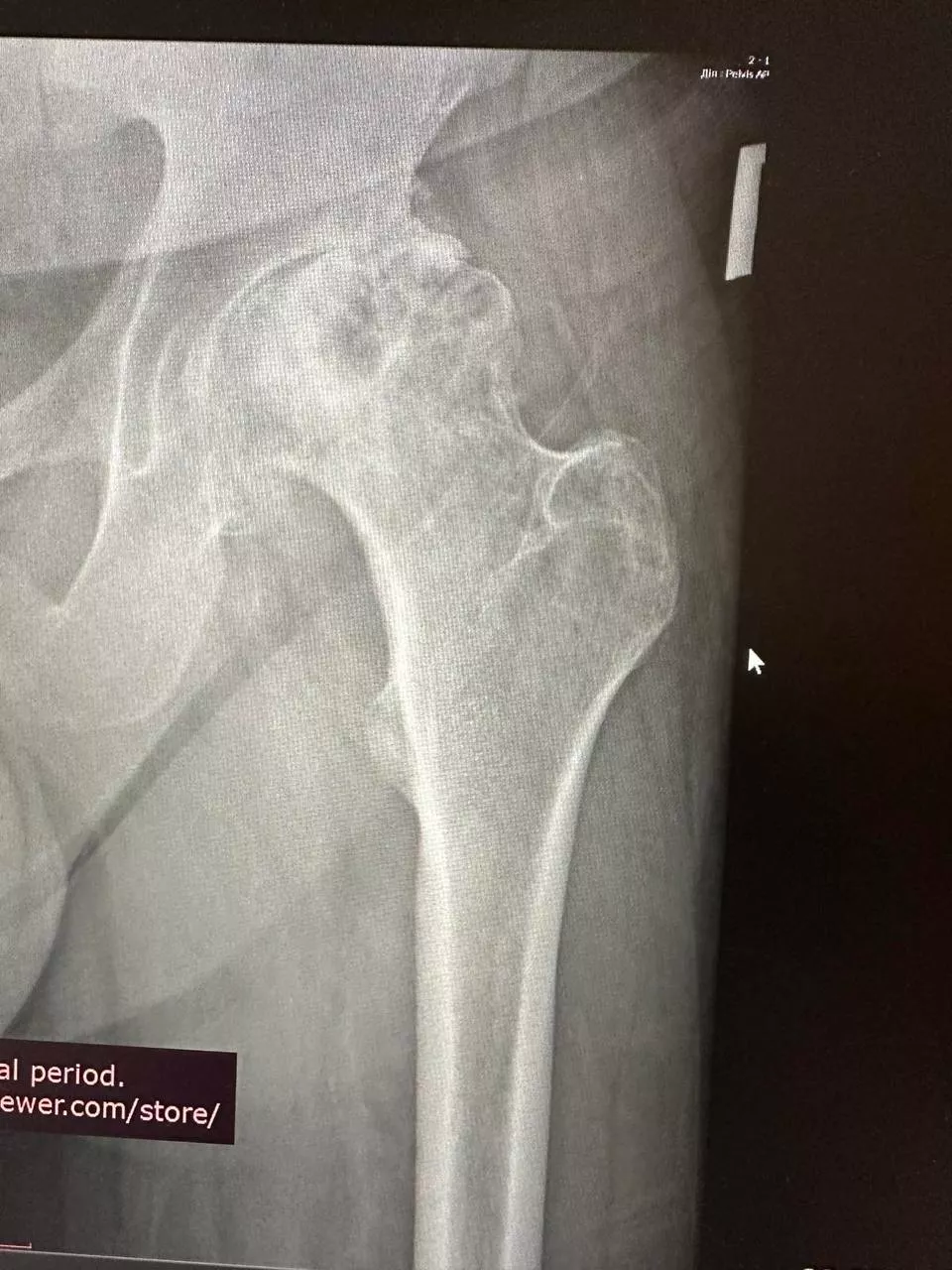 Пацієнт №4 - До 